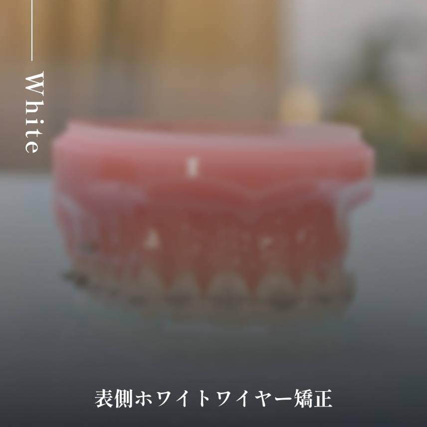 表側ワイヤー矯正(ラビアル矯正)