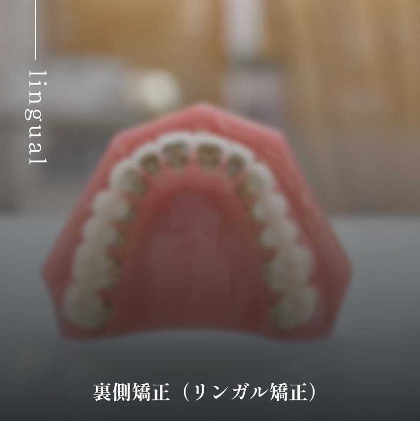 裏側矯正(リンガル矯正)